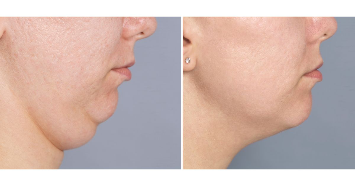 Podbradak žena pre i posle